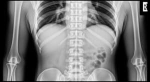 spinal cord injury car accident North Carolina