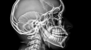 concussion after car accident North Carolina