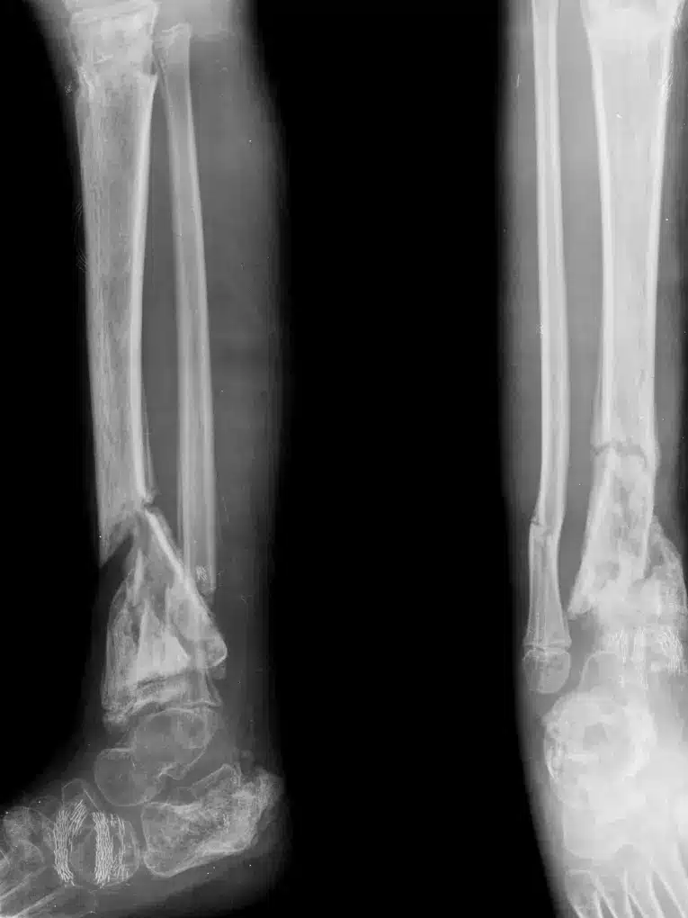 leg fracture xray after car accident